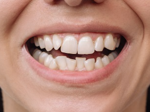 Before treatment: Crowded and rotated upper front teeth before treatment, aligned smile after invisible braces